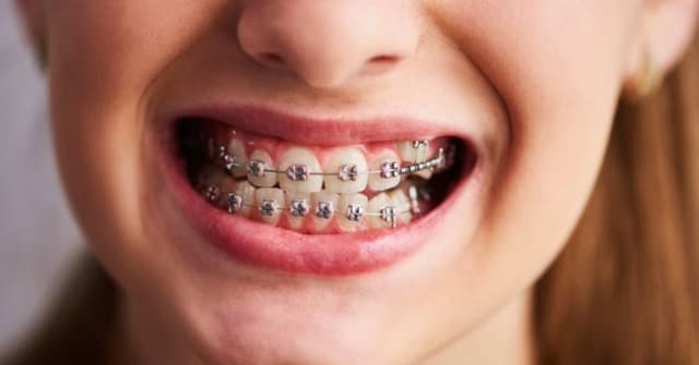 Orthodontic Treatment