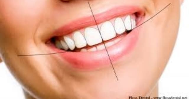 Smile Designing